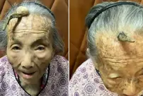 A 107-year-old woman in China has developed a horn on her forehead.