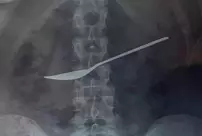 A woman who went to the hospital with complaints of stomach pain had a 20-centimeter spoon removed from her stomach.