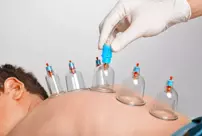 Family doctors are getting the authority to perform cupping and acupuncture.