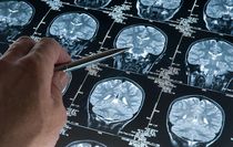 Araştırma: Alzheimer düşünüldüğünden daha erken başlayabilir