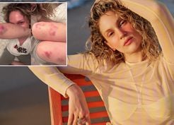 >Farah Zeynep Abdullah'ın vücudundaki morluklar korkuttu