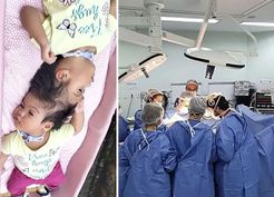 Yapışık ikizlerden acı haber: Kalpleri 14 dakika arayla durdu