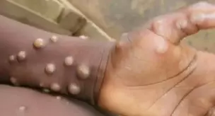 The first case of M flower was detected in Madagascar.