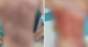 في أرنافوتكوي، ادعاء تنمّر بين الأقران: أحرقوا ظهر طفل يبلغ من العمر 12 عامًا بالكولونيا