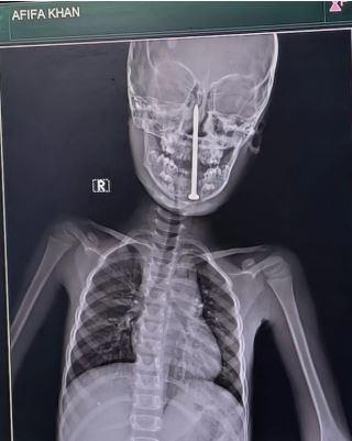 Beynine çivi saplanan küçük kız mucizevi şekilde kurtarıldı