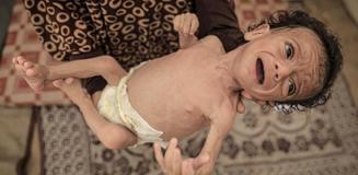24 saatte 6 kişi daha açlıktan öldü, 7 aylık Salim bebeğin hayatı tehlike altında