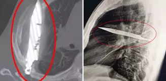 Göğüs ağrısıyla hastaneye gitti, göğsünde 8 yıldır bıçakla yaşadığı ortaya çıktı!