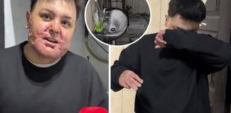 65 ameliyat geçirdi, 12 gün uyutuldu! Hayatı saniyeler içinde kabusa döndü 65 ameliyat geçirdi, 12 gün uyutuldu! Hayatı saniyeler içinde kabusa döndü