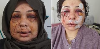 Polis eşi tarafından darbedildiği iddiasıyla şikayetçi oldu