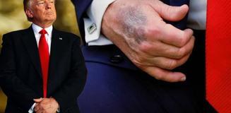 Trump elindeki morluğun nedenini açıkladı Trump elindeki morluğun nedenini açıkladı