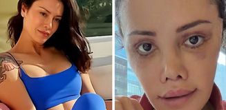 Yüz nakli yaptıran Didem Ceran'ın son hali: Harika gözüküyorum