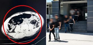 Batman’da akıllara durgunluk veren olay: Yolcu otobüsünde yakalanan 4 şüphelinin midesinden kilo kilo uyuşturucu çıktı Batman’da akıllara durgunluk veren olay: Yolcu otobüsünde yakalanan 4 şüphelinin midesinden kilo kilo uyuşturucu çıktı