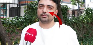 Burun ameliyatına girdi, başına gelmeyen kalmadı! İşini bile kaybetti