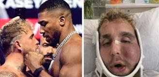 Suratı tanınmaz hale gelen Jake Paul'un ne kadar kazandığını duyunca şok olacaksınız