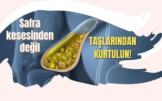 Safra kesesinden değil taşlarından kurtulun!