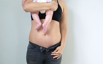 Doğum sonrası vücut estetiği: karın germe, meme estetiği & liposuction