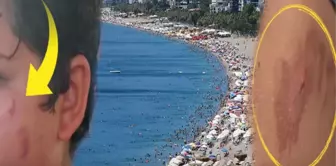 Citizens are uneasy! Those who swim in the sea are coming out with burns.