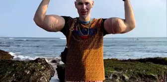 Russian Captain Nemo's arms are in danger: Dangerous injections have led to a severe infection.