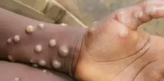 The first case of M flower was detected in Madagascar.