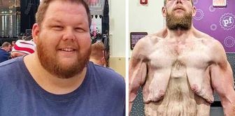 He lost 163 kilos, but his suffering is not over.