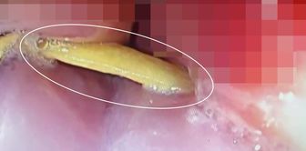 A 5-centimeter bone stuck in his throat was killing him.