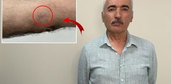 The 1-centimeter wound on your arm turned out to be cancer.