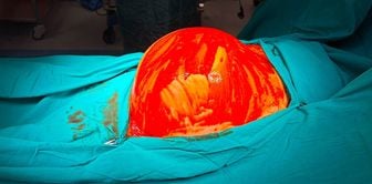 Giant kidney tumor was removed with surgery