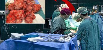 One-third of the patient's weight was removed from their uterus.