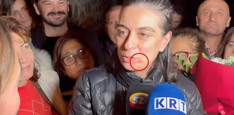 The cause of the redness at the corner of Sinem Dedetaş's lip has become clear