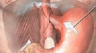 Gastroözofageal Reflüde TİF Tanısı ve Tedavisi