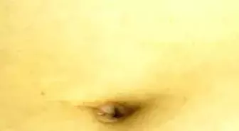 Göbek Deliğinden Kasık Fıtığı Ameliyatı Yapıldı