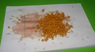 İdrar Torbasından 500 Taş Çıktı