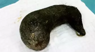 Ameliyatla Midesinden 800 Gram Saç Çıkarıldı