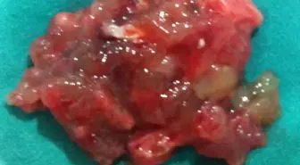 Çomü Tıp Fakültesi'nde Açık Kalp Ameliyatı