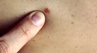 Deri Kanserine Karşı Benlere Dikkat