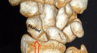 Skafoid Kemiği Nedir ve İşlevi Nedir?