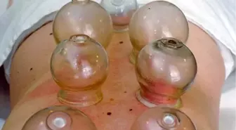 Evde 'Bardak Çekme', Hastanede 'Kupa Terapisi'