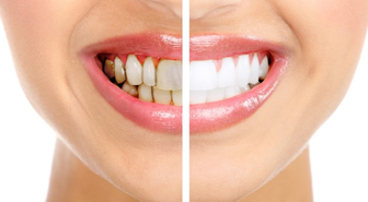 Diş Sağlığı İçin Beslenme Tüyoları