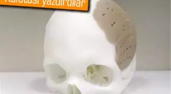 3d Yazıcı ile Üretilen Kafatası Bir Hastaya Takıldı