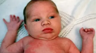 Kızamık Vaka Sayısı Azalıyor