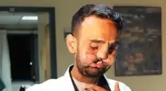 Türkiye'nin 5'inci Yüz Nakli