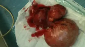 Karnından 19 Kilo Kitle Çıktı