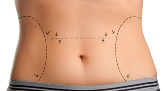 Abdominoplasti ile 30 Kilo Vermek ve 6 Beden İncelmek Mümkün