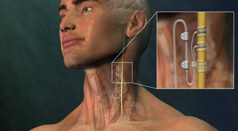 Epilepsi Nöbetlerine 'Pilli' Çözüm