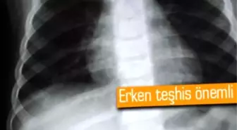 Akciğer Kanserinde Erken Teşhis İmkanı: E-Burun