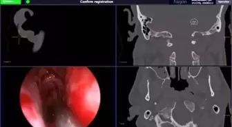Sinüzit Ameliyatında 'Yol Bulucu' Mucizesi