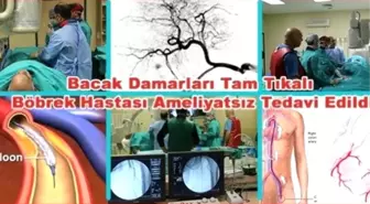 Diyaliz Hastasının Tıkalı Olan Bacağı Ameliyatsız Yöntemle Kesilmekten Kurtuldu