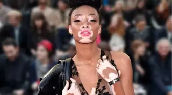 Hastalığını Avantaja Çevirdi: Winnie Harlow