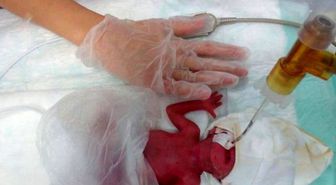 380 Gramlık Azra Bebek Yaşama Tutundu