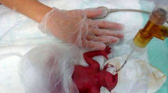 Görüntülü Haber) 380 Gramlık Azra Bebek Yaşama Tutundu